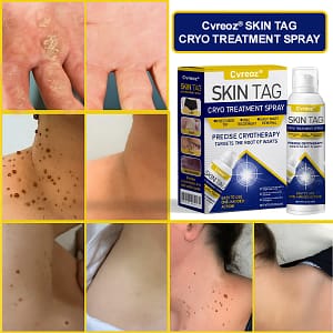 Cvreoz® Skin Tag Cryo Treatment Spray