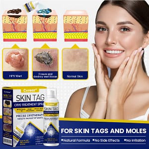 Cvreoz® Skin Tag Cryo Treatment Spray