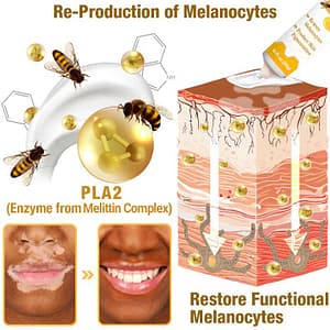 LOVILDS™ Melittin Complex Vitiligo Treatment Cream