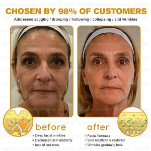 ADNOON™ Botox & Bee Venom Skin Treatment Cream