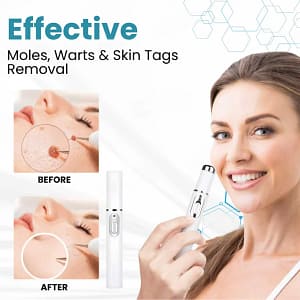 Lovilds® Non-Invasive Mole and Wart Removal Laser Pen