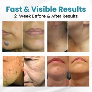 Lovilds® Non-Invasive Mole and Wart Removal Laser PenLovilds® Non-Invasive Mole and Wart Removal Laser Pen