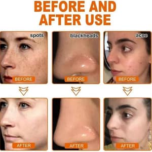 LOVILDS™ Whitening and Freckle – Removing Mask