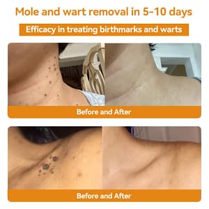 LOVILDS™ TagRecede Bee Venom Treatment Cream