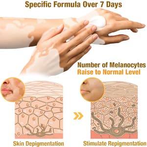 LOVILDS™ Melittin Complex Vitiligo Treatment Cream