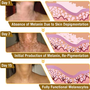 LOVILDS™ Melittin Complex Vitiligo Treatment Cream