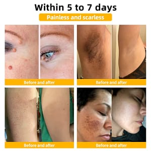 LOVILDS™ TagRecede Bee Venom Treatment Cream