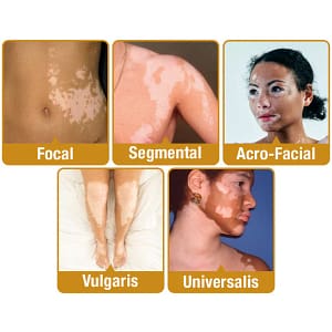 LOVILDS™ Melittin Complex Vitiligo Treatment Cream