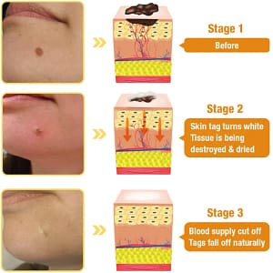 LOVILDS™ TagRecede Bee Venom Treatment Cream