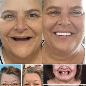 Hidone® Advanced Customized Full Denture Set