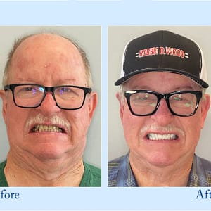 Hidone® Advanced Customized Full Denture Set