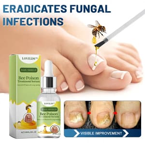 LOVILDS™ Nail Fungus Bee Poison Treatment Serum