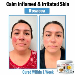 LOVILDS™ Bee poison Multi-Symptom Skin Treatment Cream