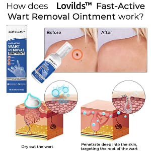 LOVILDST™ Fast-Active Wart Removal Ointment