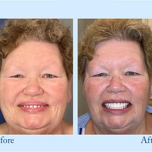 Hidone® Advanced Customized Full Denture Set