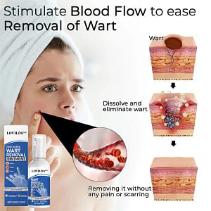 LOVILDST™ Fast-Active Wart Removal Ointment