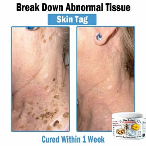 LOVILDS™ Bee poison Multi-Symptom Skin Treatment Cream