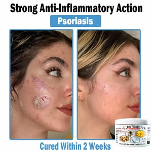 LOVILDS™ Bee poison Multi-Symptom Skin Treatment Cream
