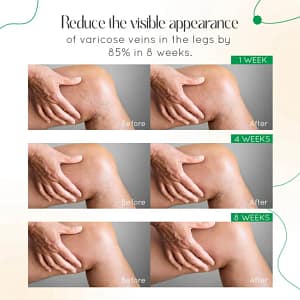 LOVILDS™ Vein Therapy Cream