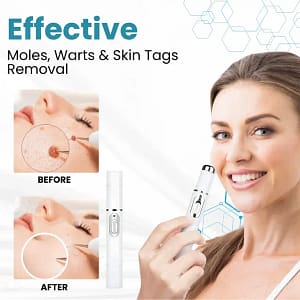 LAOZIK® Non-Invasive Mole and Wart Removal Laser Pen
