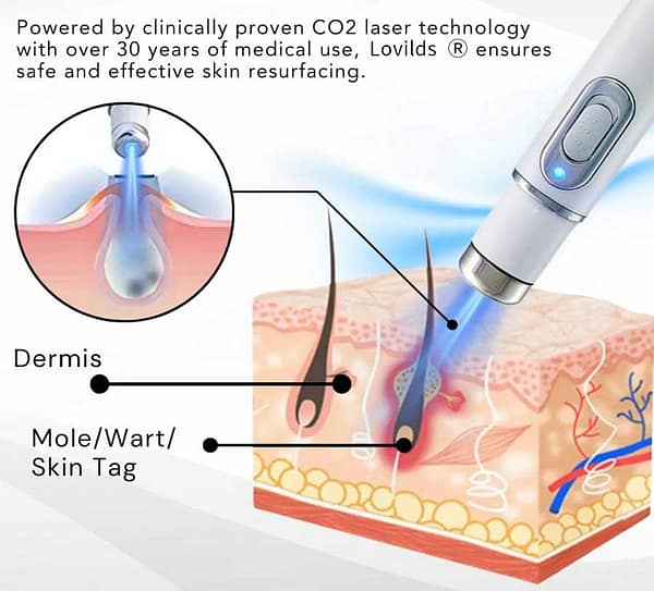 Lovilds® Non-Invasive Mole and Wart Removal Laser Pen