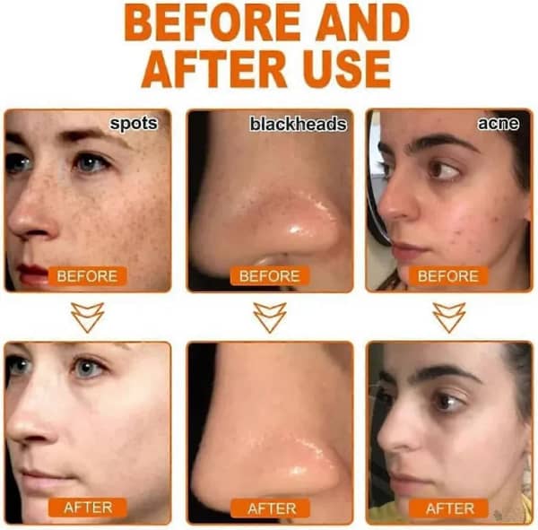 LOVILDS™ Whitening and Freckle – Removing Mask