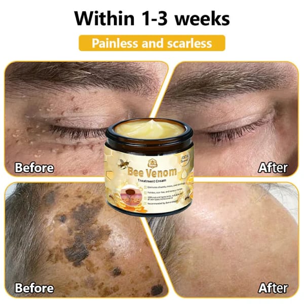 Turonu™ Bee Venom Treatment Cream