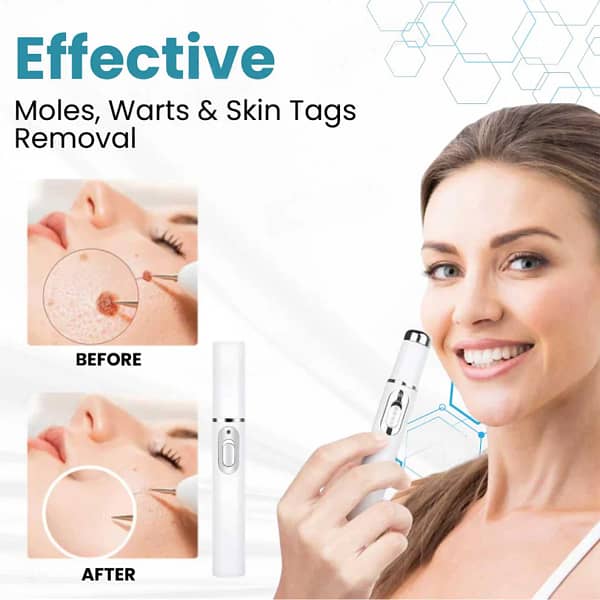 Lovilds® Non-Invasive Mole and Wart Removal Laser Pen