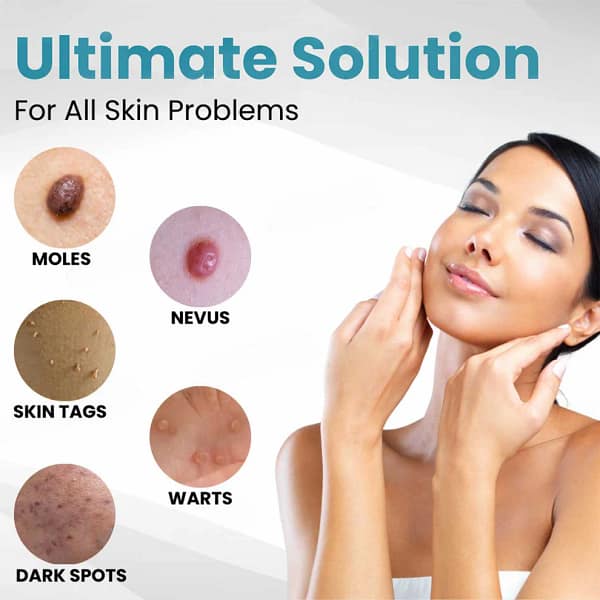 Lovilds® Non-Invasive Mole and Wart Removal Laser Pen