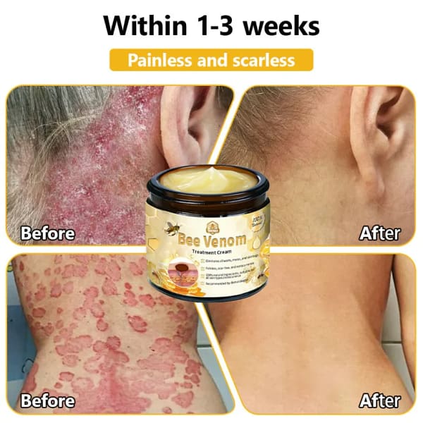 Turonu™ Bee Venom Treatment Cream