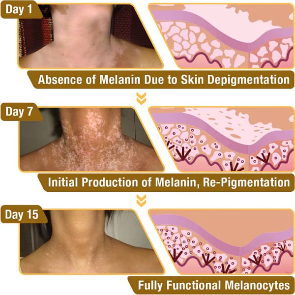 LOVILDS™ Melittin Complex Vitiligo Treatment Cream