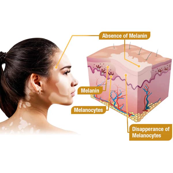 LOVILDS™ Melittin Complex Vitiligo Treatment Cream