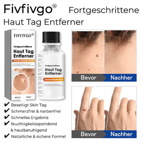 Fivfivgo® Bee Venom Tags & Moles Remover