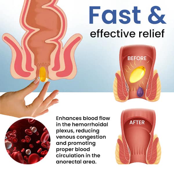 Cvreoz® Natural Hemorrhoid Capsules