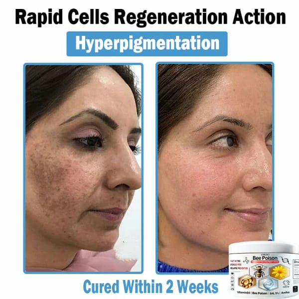 LOVILDS™ Bee poison Multi-Symptom Skin Treatment Cream