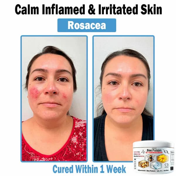 LOVILDS™ Bee poison Multi-Symptom Skin Treatment Cream