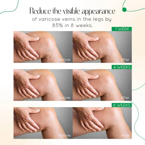 LOVILDS™ Vein Therapy Cream