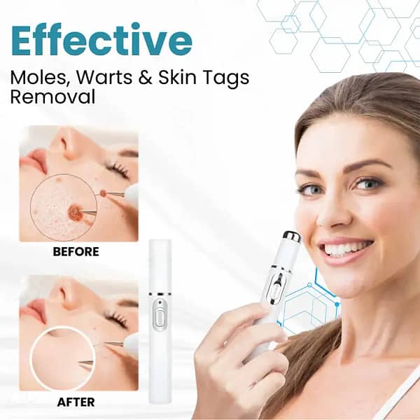LAOZIK® Non-Invasive Mole and Wart Removal Laser Pen
