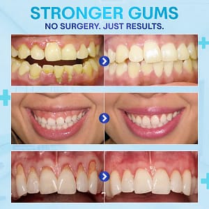 BQYOOM™ Gum Therapy Agent