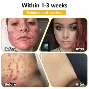 Turonu™ Bee Venom Treatment Cream