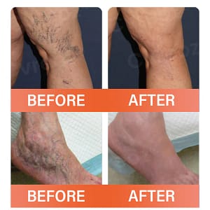 Oveallgo® VeinEase Microneedle Therapy Patch