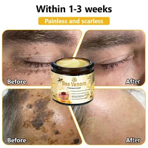 Turonu™ Bee Venom Treatment Cream