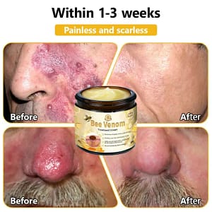 Turonu™ Bee Venom Treatment Cream