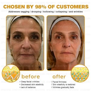 ADNOON™ Botox & Bee Venom Skin Treatment Cream