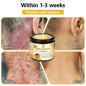 Turonu™ Bee Venom Treatment Cream