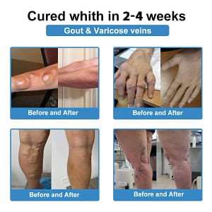 Fivfivgo® Nano-Microneedle Joint Patch