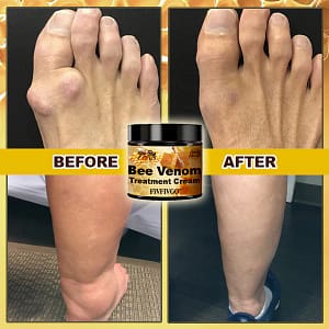 Fivfivgo™ Arthritis Treatment Bee Venom Cream