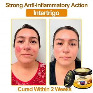ADNOON™ Botox & Bee Venom Skin Treatment Cream