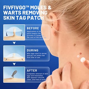 Fivfivgo™ Moles & Warts Removing Skin Tag Patch