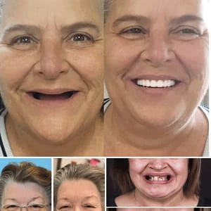 Hidone® Advanced Customized Full Denture Set
